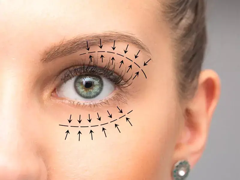 بلفاروپلاستی با لیزر، کاربرد و مزایای آن